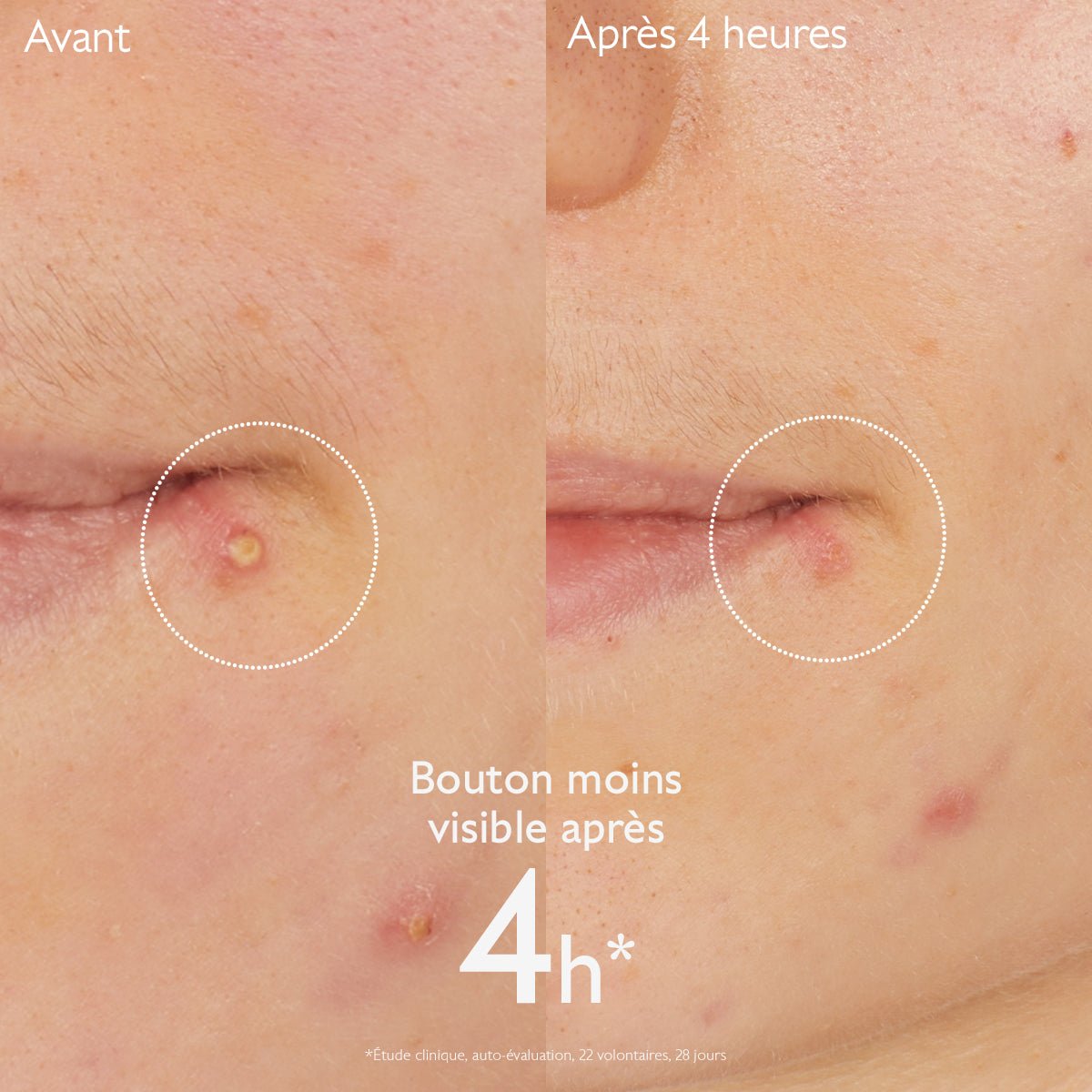 Caudalie Vinopure Stop Boutons Salicylique 15ml - La Grande Para